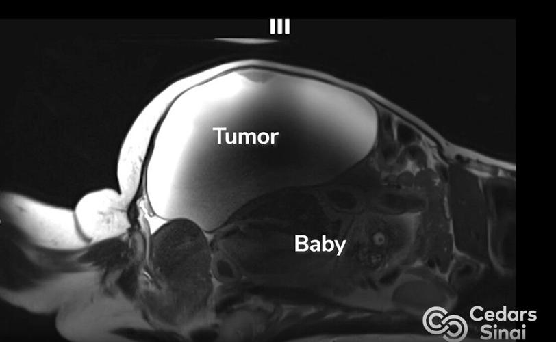 TumorImage.jpg